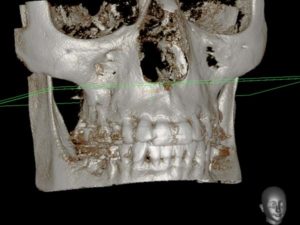 clínica abellás, tac dental 3D